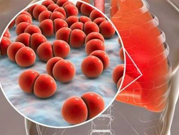 Cuba nghiên cứu phát triển vaccine chống lại phế cầu khuẩn