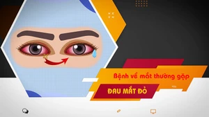 [Video] Chủ động phòng, chống bệnh đau mắt đỏ trong mùa mưa