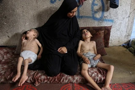 Trẻ em bị suy dinh dưỡng tại Dải Gaza. (Ảnh: THX/TTXVN)