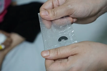 [Video] Thông tin ca bệnh: Dị vật bỏ quên-cúc áo