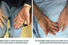 Hút nhiều cục máu đông giúp bệnh nhân 97 tuổi tránh nguy cơ hoại tử