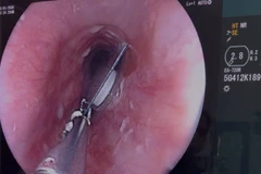 Viên thuốc còn nguyên bao kẽm kẹt trong thực quản người bệnh.