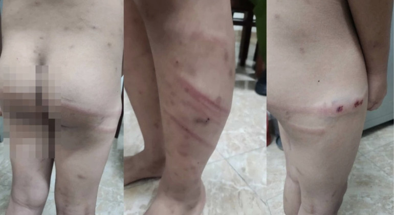 Em M bị đối tượng Hùng bạo hành gây thương tích nghiêm trọng.