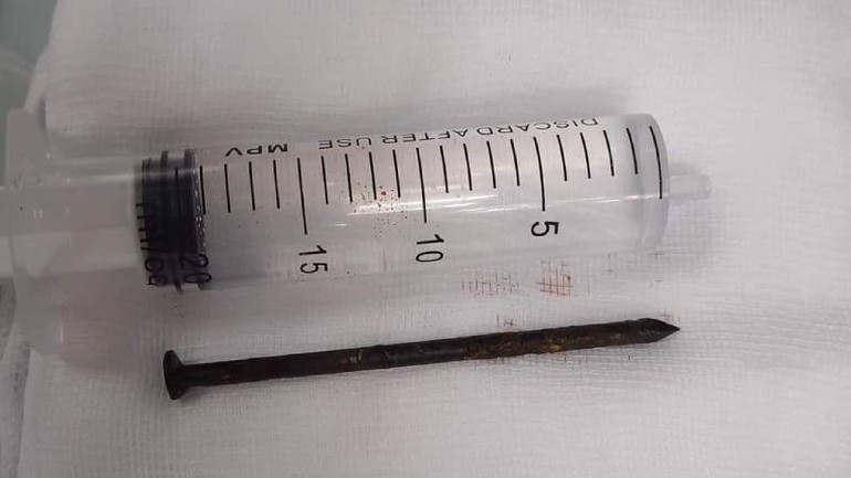 Dị vật trong não người bệnh một năm nay là chiếc đinh thép dài vừa được phẫu thuật lấy ra.