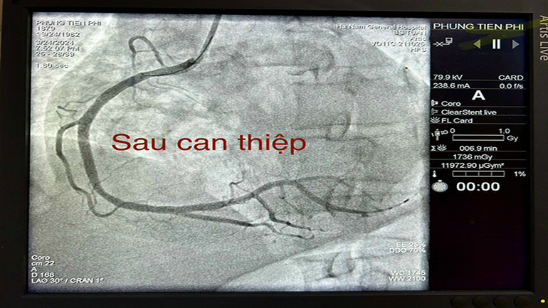Hình ảnh động mạch vành của bệnh nhân Phùng Tiến Phi sau khi được can thiệp. (Ảnh: Bệnh viện Đa khoa tỉnh Hà Nam cung cấp) Hình ảnh động mạch vành của bệnh nhân Phùng Tiến Phi sau khi được can thiệp. (Ảnh: Bệnh viện Đa khoa tỉnh Hà Nam cung cấp)