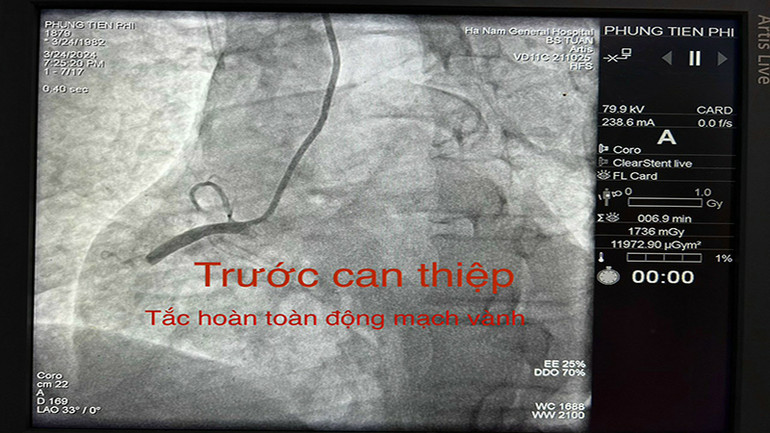 Hình ảnh động mạch vành trước khi can thiệp của bệnh nhân Phùng Tiến Phi. (Ảnh: Bệnh viện Đa khoa tỉnh Hà Nam cung cấp) Hình ảnh động mạch vành trước khi can thiệp của bệnh nhân Phùng Tiến Phi. (Ảnh: Bệnh viện Đa khoa tỉnh Hà Nam cung cấp)