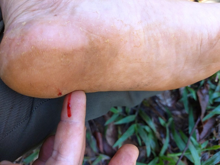 Mặc dù được trang bị giày bảo hộ nhưng đinh vẫn xuyên qua đế cao-su khiến nhân viên bảo vệ rừng bị thương tích.