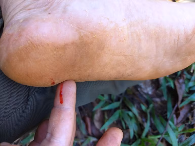 Mặc dù được trang bị giày bảo hộ nhưng đinh vẫn xuyên qua đế cao-su khiến nhân viên bảo vệ rừng bị thương tích.