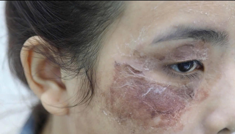 Một trường hợp bệnh nhân khác cũng nhập viện sau peel da và được điều trị tại Bệnh viện da liễu Thành phố.