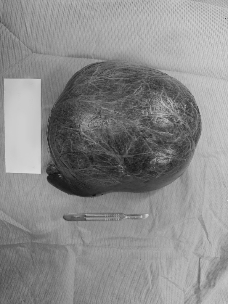 Khối u gan nặng đến 3kg chiếm hầu hết nửa trên khoang bụng và hơn 80% thể tích gan.