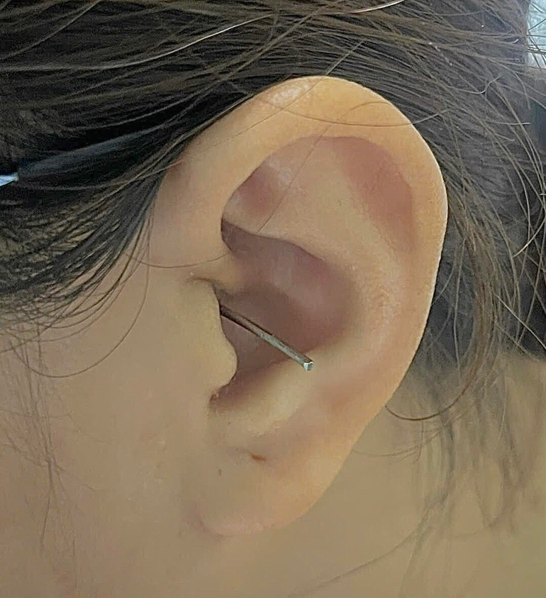 Một phần của cây ráy tai dính vào lỗ tai bên trái của người bệnh.