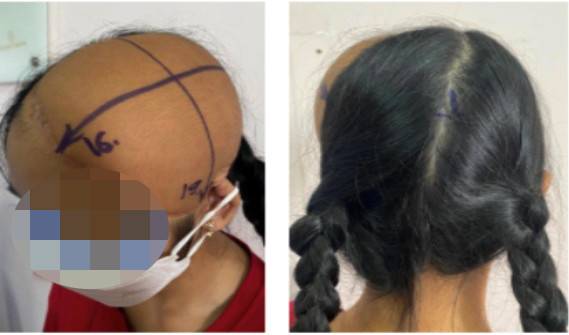 Kết quả sau khi thực hiện kỹ thuật giãn mô để điều trị cho bé