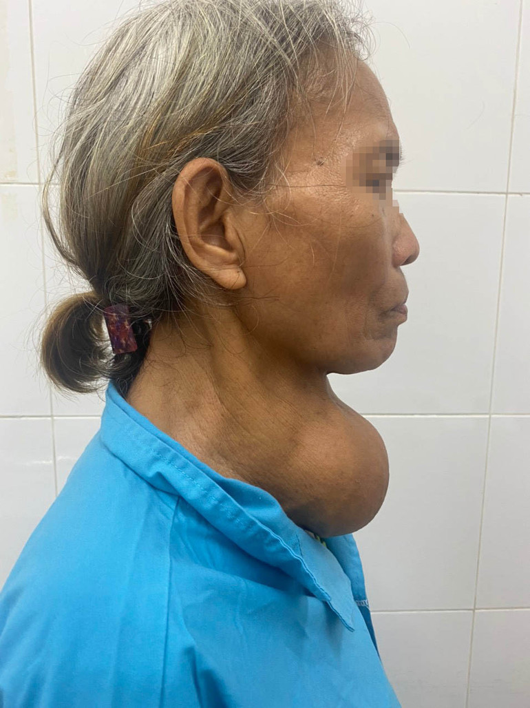 Hình ảnh khối u tuyến giáp trên cổ bệnh nhân trước phẫu thuật.