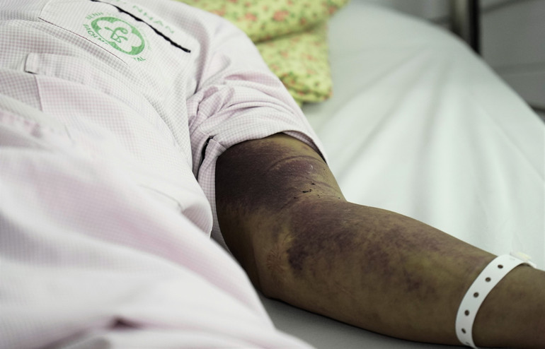 Những cơn sốt đã hạ, cơn choáng đã qua, nhưng toàn bộ cơ thể anh bị xuất huyết ngoài da, bầm tím. Chỉ số tiểu cầu đang hồi phục dần.