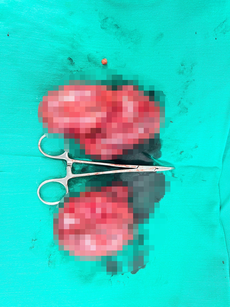 Khối u giáp “khổng lồ” sau khi được cắt thành công.