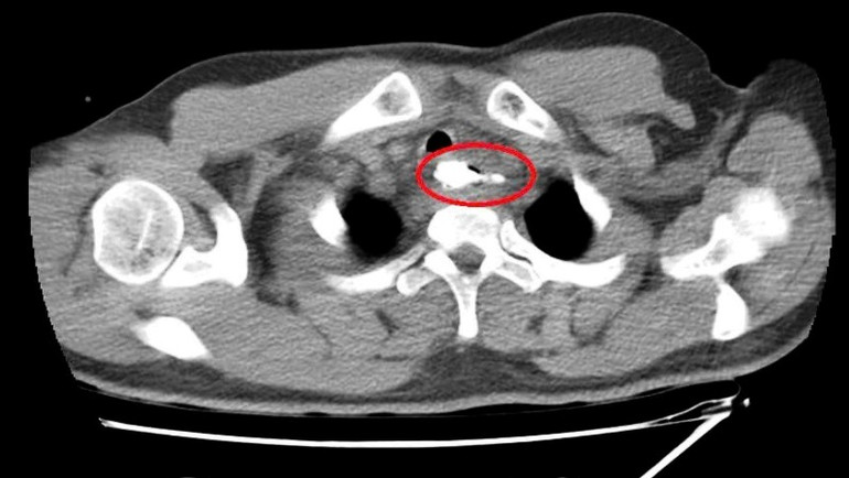 Dị vật là mẩu xương heo, có mấu nhọn, kích thước 30x41mm, nằm ở thực quản đoạn ngực, cách cung răng trên 20cm.