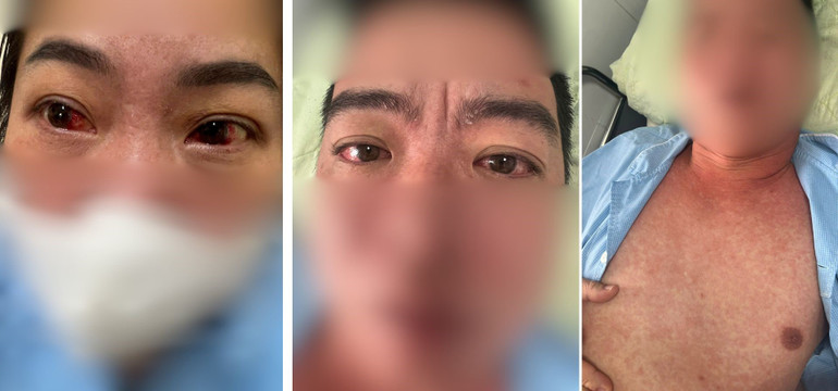 Bệnh sởi có thể gây ra những biến chứng nguy hiểm như: viêm não, viêm đường phổi, viêm kết mạc, viêm giác mạc và các loại nhiễm trùng khác ảnh hưởng lớn đến sức khỏe, thậm chí nguy hiểm đến tính mạng.