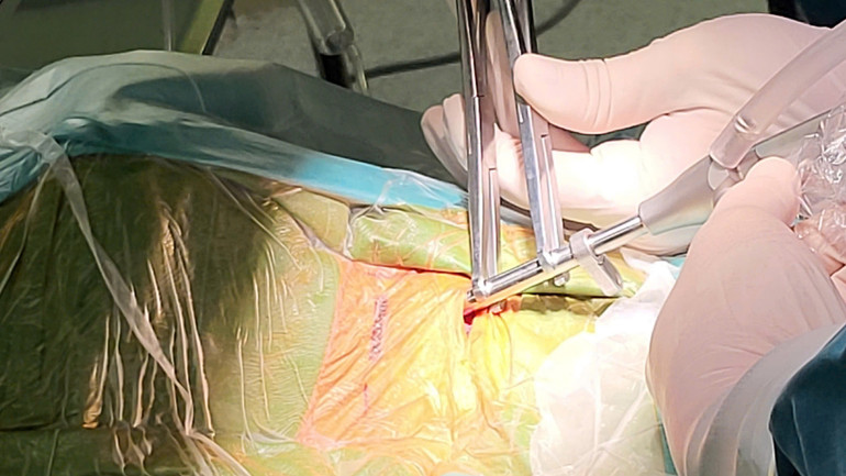 Hình ảnh ống phẫu thuật nội soi được đưa qua vết mổ 1 cm.