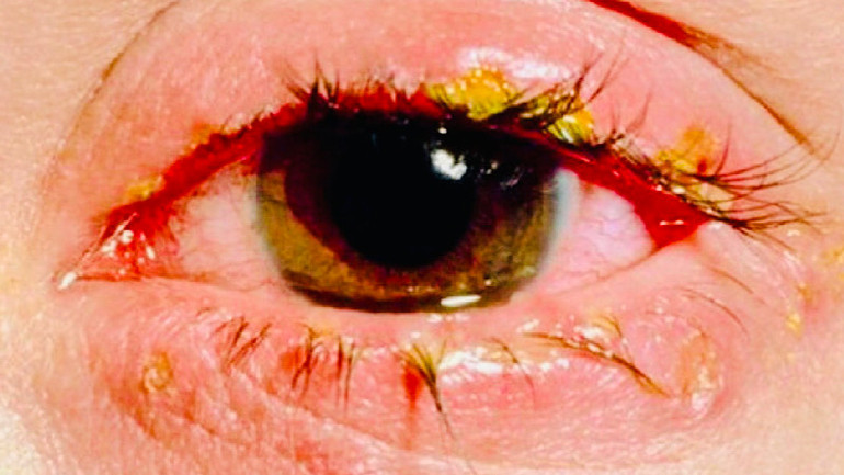 Bệnh đau mắt đỏ không được điều trị đúng cách dễ gây biến chứng, ảnh hưởng đến thị lực người bệnh.