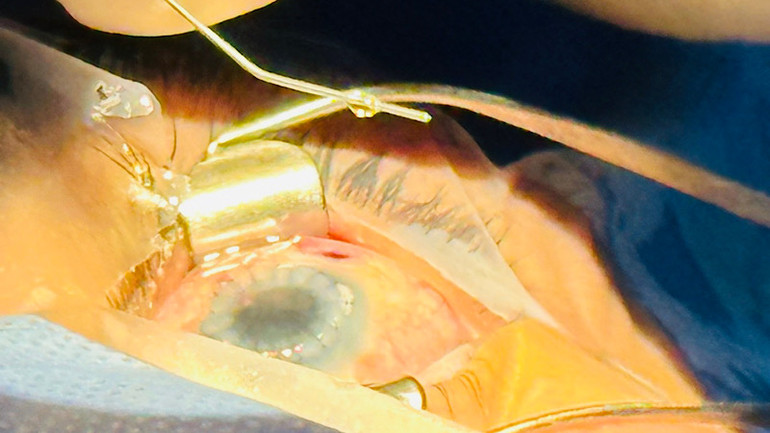 Thực hiện phẫu thuật ghép giác mạc.