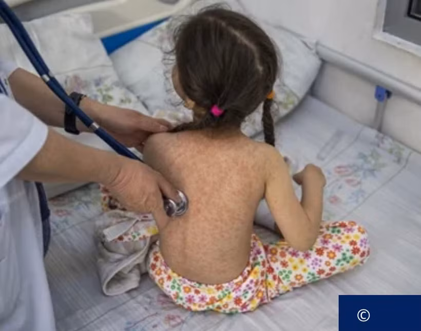 Một bé gái mắc bệnh sởi. (Ảnh minh họa: WHO)