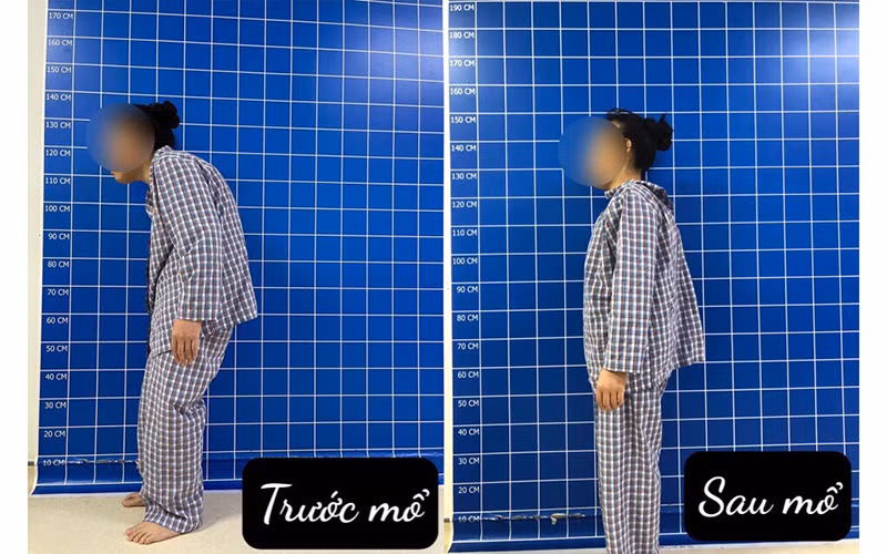 Bệnh nhân đã được can thiệp chỉnh gù cột sống thành công. 
