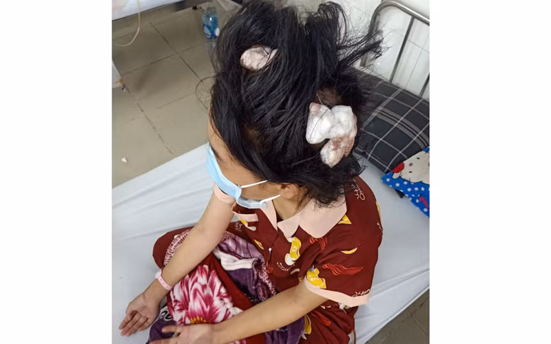 Nạn nhân bị "cha dượng" đánh đập dã man phải vào bệnh viện cấp cứu.