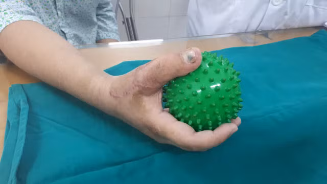 Phẫu thuật chuyển ngón chân thành ngón tay cho thanh niên 17 tuổi -0