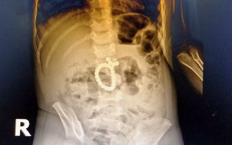 Nghệ An: Cấp cứu thành công bệnh nhân nhi nuốt 25 viên bi nam châm, thủng ruột và tá tràng -0