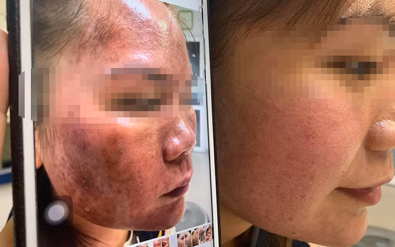 Bệnh nhân đã bớt phù nề, bỏng da sau một tuần điều trị.