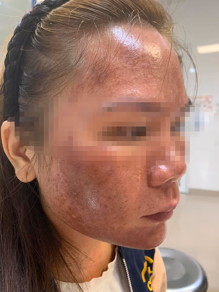 Bỏng da mặt vì hóa chất từ thuốc lột da trôi nổi -0