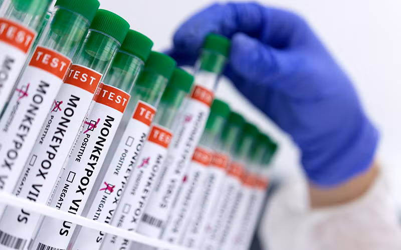 Ống đựng mẫu bệnh phẩm có đánh dấu dương tính với virus gây đậu mùa khỉ. (Ảnh: Reuters)
