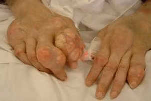 Gout khiến bệnh nhân rất đau đớn và bị biến dạng khớp, có thể dẫn đến tàn tật.