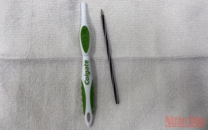 Nội soi lấy bàn chải đánh răng và ruột bút bi trong dạ dày -0