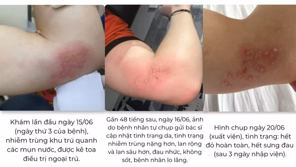 Diễn tiến điều trị ca zona tại Bệnh viện quốc tế City.