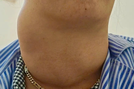 Ca bướu giáp khổng lồ ở bệnh nhân 41 tuổi.