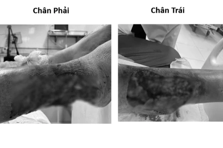 Bệnh nhân nữ nhập viện trong tình trạng tổn thương lóc da vùng cẳng chân hai bên do tai nạn giao thông, vết thương có nguy cơ hoại tử. (Ảnh: BVCC)