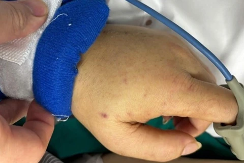 Ban xuất huyết trên cơ thể người bệnh.