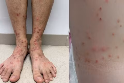 Hình ảnh sẩn ngứa do bọ chét.
