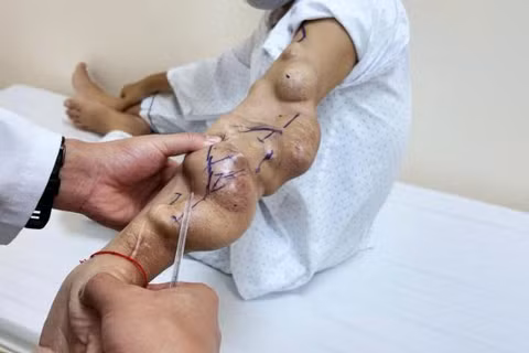 Các khối phình phát triển liên tiếp trên cầu nối AVF khiến cánh tay biến dạng, thành mạch căng mỏng và dọa vỡ bất cứ lúc nào. 