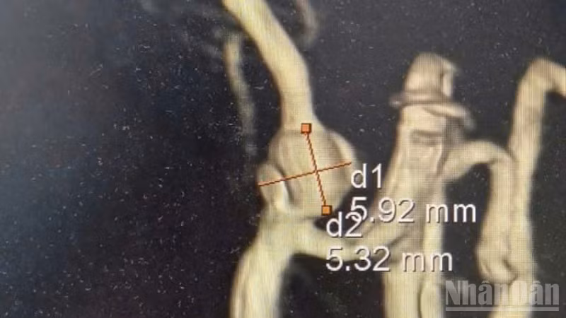 Ghi nhận bệnh nhân Sơn Phương có túi phình động mạch đốt sống kích thước khoảng 5,92x5,32mm.