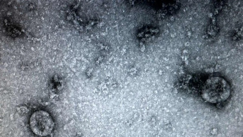 Các nhà nghiên cứu từ Đại học Y khoa Sechenov của Nga cảnh báo những người từng bị nhiễm virus SARS-CoV-2 đều có thể mắc một căn bệnh nguy hiểm: Hoại tử xương. (Ảnh: TTXVN)