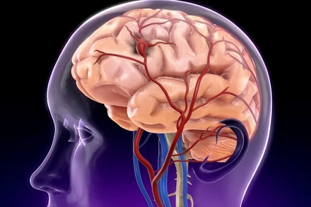 [Video] Vỡ mạch máu và tắc nghẽn: Hai nguyên nhân chính gây đột quỵ