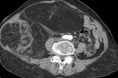 Hình ảnh phim chụp CT ổ bụng của người bệnh.