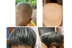 Hình ảnh da đầu cháu bé trước và sau khi điều trị.