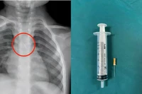 Dị vật trong đường thở của bệnh nhi. (Ảnh: Bệnh viện Đa khoa tỉnh Quảng Trị)