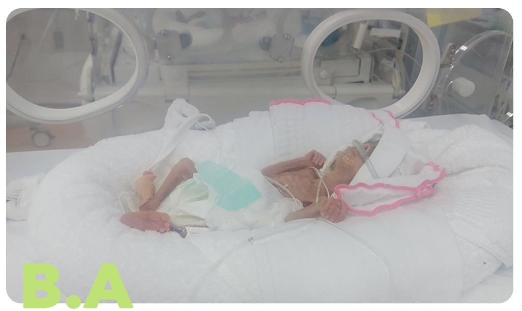 Bé B.A chào đời chỉ nặng 400g, cơ thể suy dinh dưỡng. Bé B.A chào đời chỉ nặng 400g, cơ thể suy dinh dưỡng.