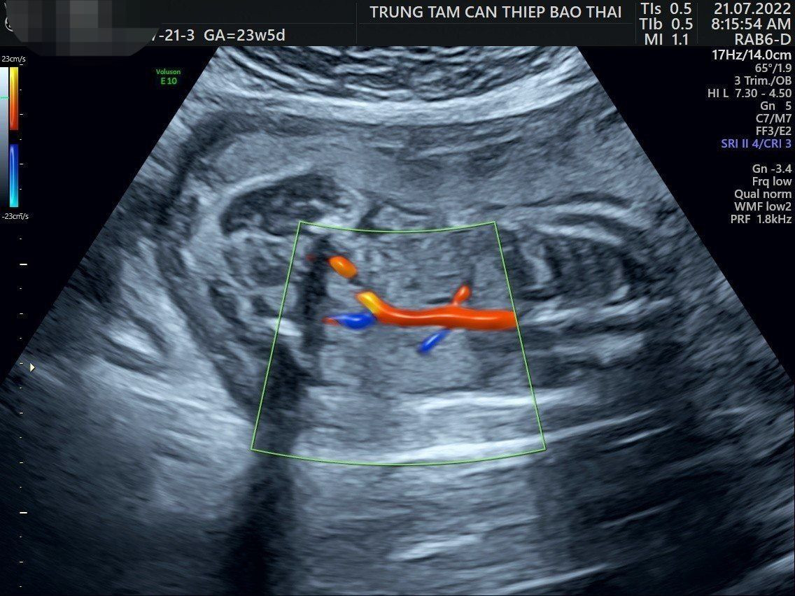 Hình ảnh siêu âm hình thái bào thai của sản phụ O.