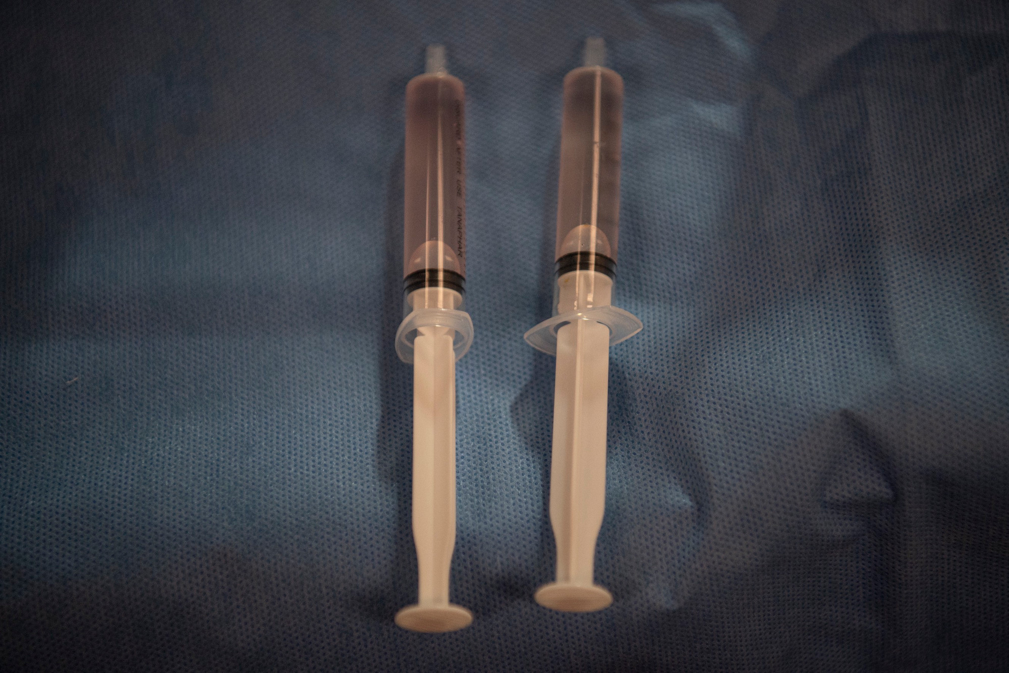 Kết quả xét nghiệm tế bào từ nước ối cho thấy bào thai mang đột biến gen ACE liên quan đến loạn sản thận.