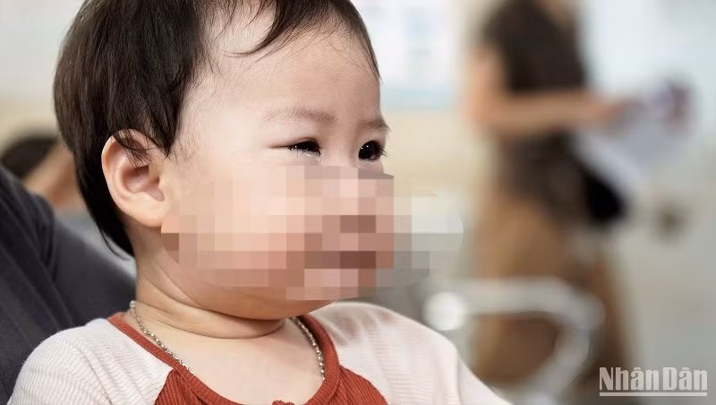 Em bé bị lây đau mắt từ anh trai đi học mẫu giáo.